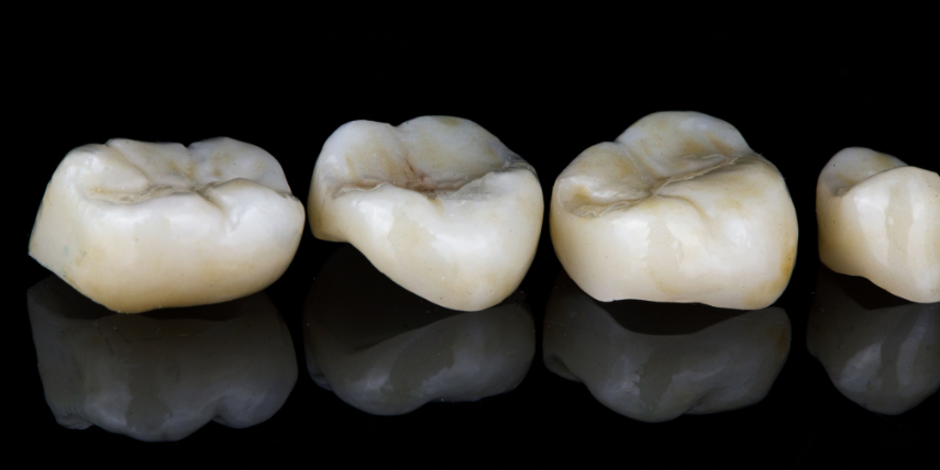 Inlays et onlays céramiques